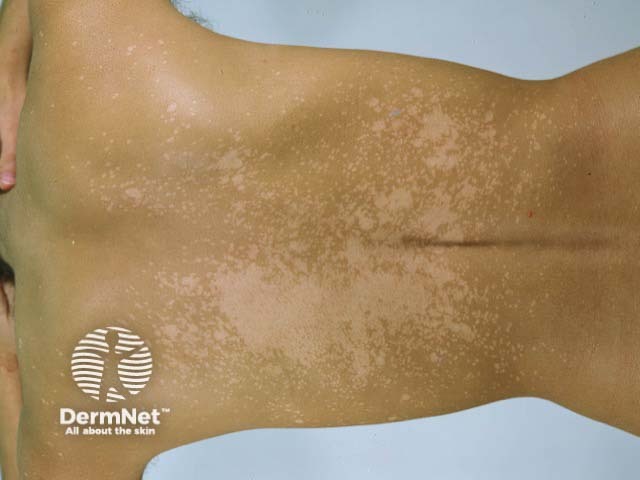 Extensive confluent hypopigmented pityriasis versicolor on the back