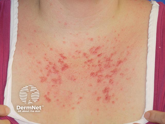 Erythematous papules on the recently sun-exposed 'V' area of the chest due to polymorphic light eruption