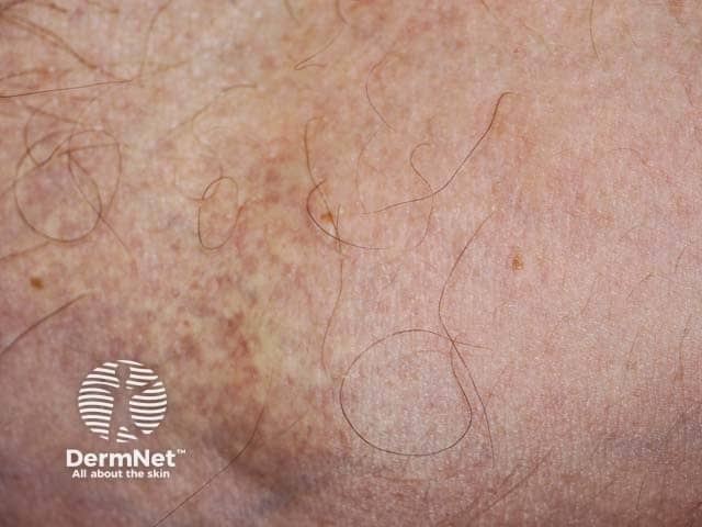 Pseudoxanthoma elasticum presenting on antecubital fossa in a patient with associated PXE blindness