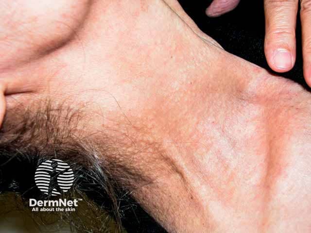 Yellow papules of PXE on the neck producing a