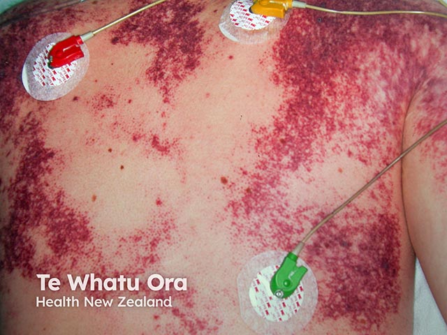 Purpura fulminans over the chest