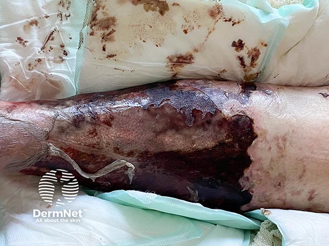 A necrotic eschar on the leg due to purpura fulminans