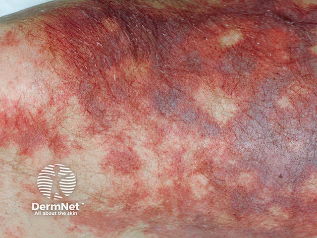 Purpura, incipient necrosis, and blistering due to purpura fulminans