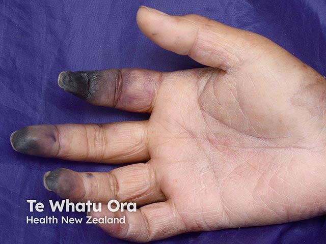 Digital gangrene in purpura fulminans