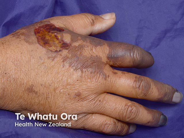 Purpura fulminans with digital gangrene, and blisters due to incipient skin necrosis