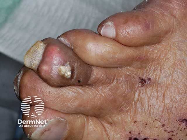 Pyoderma gangrenosum on the toe - more typical lesions were present on the legs