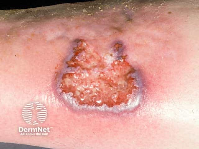 The classical violaceous edge of pyoderma gangrenosum