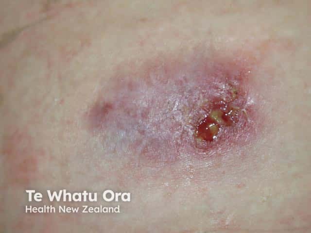 Pyoderma gangrenosum over the deltoid area