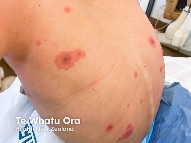 Vesicobullous targetoid skin lesions in RIME