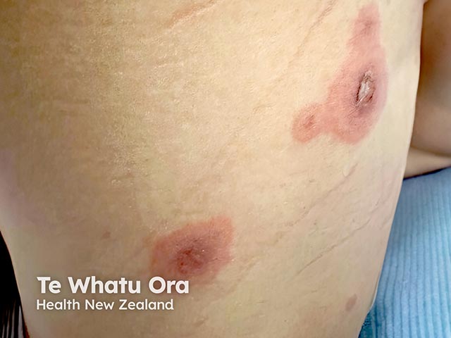 Target lesions on the back in reactive mucocutaneous eruption due to mycoplasma