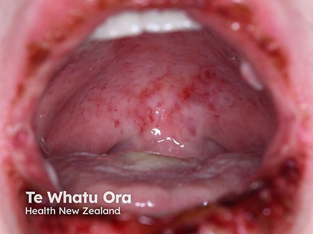Severe oral and labial erosions in RIME