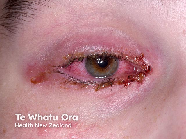 Crusting on the eyelids and a severe conjunctivitis due to RIME