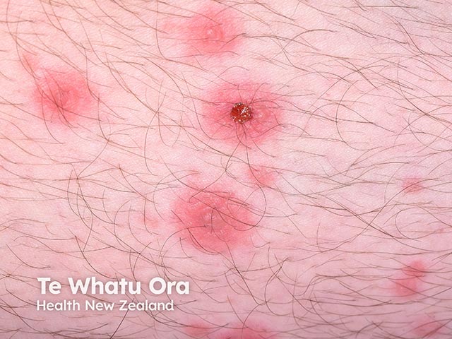 Central blistering of target lesions in RIME