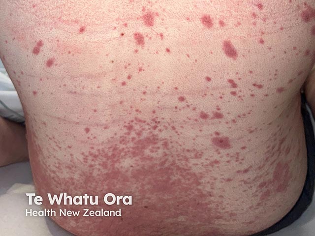 Early truncal lesions in RIME