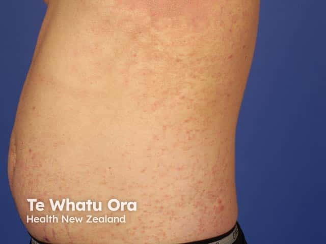 Papular lesons over the trunk in scabies