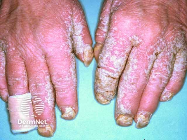 Hyperkeratotic plaques on the fingers with fissuring and nail dystrophy