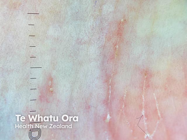 Scabies burrows on the wrist - a mite can be seen at the top of the middle burrow