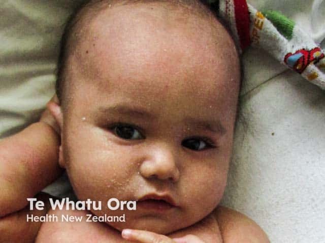 Scalp, brow and facial infantile seborrhoeic dermatitis