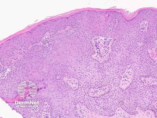Figure 4: clonal pattern