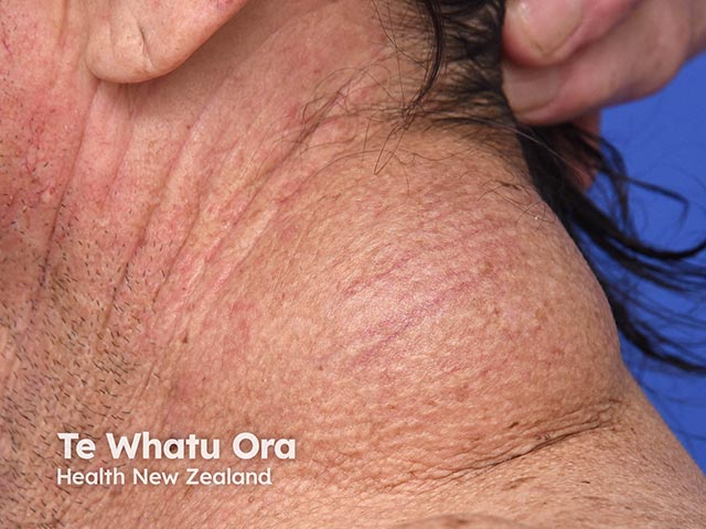 A spindle cell lipoma on the neck - a slowly growing benign tumour more common on the neck in older individuals