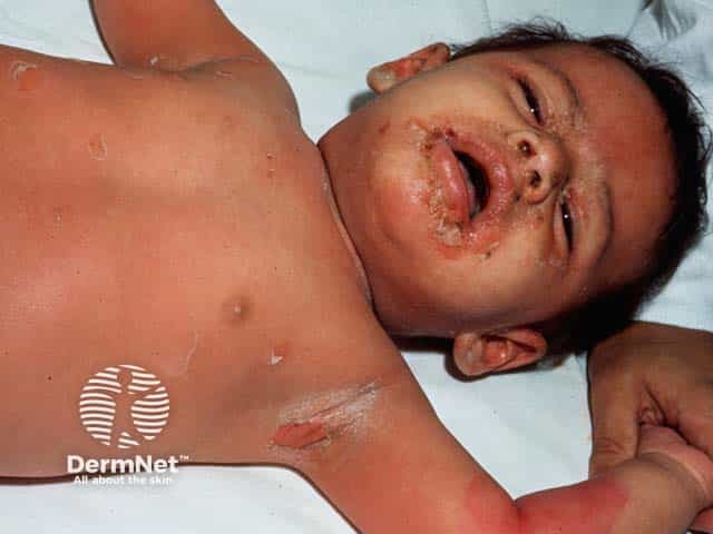 Superficial blistering over the axillae, face and chest due to staphylococcal scalded skin sydrome