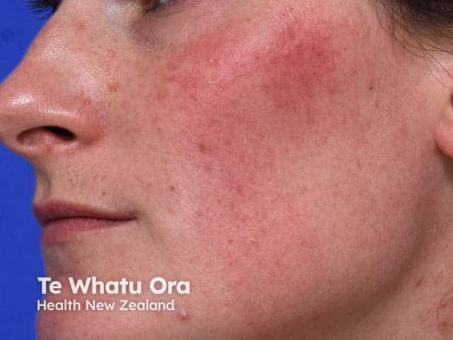 Steroid induced erythematotelangiectatic cheek rosacea