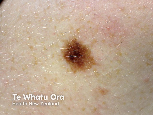 An irregularly marginated variably pigmented changing melanocytic lesion - it was a 0.5mm Breslow thickness melanoma
