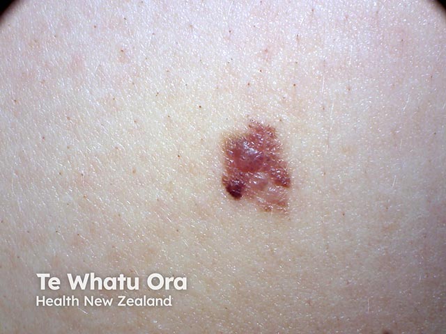 A changing irregularly pigmented lesion with a new nodule at the inferior pole - a malignant melanoma  