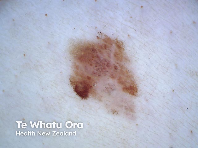 An asymmetric melanocytic lesion showing some inferior regression - a malignant melanoma