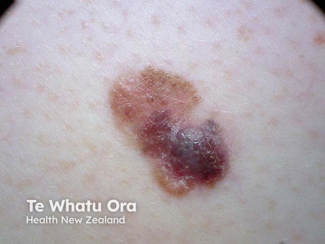 A nodule arising at the inferior pole of a melanocytic lesion - a nodular melanoma arising in a superficial spreading melanoma