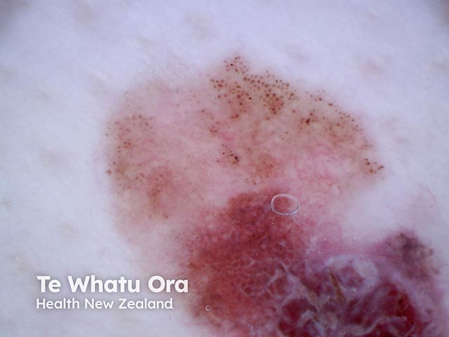 Dermoscopy of a superficial spreading malignant melanoma