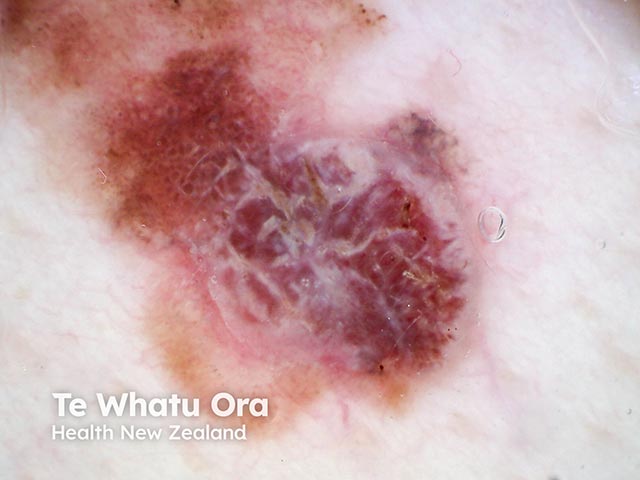 Dermoscopy of a nodule arising within a superficial spreading melanoma