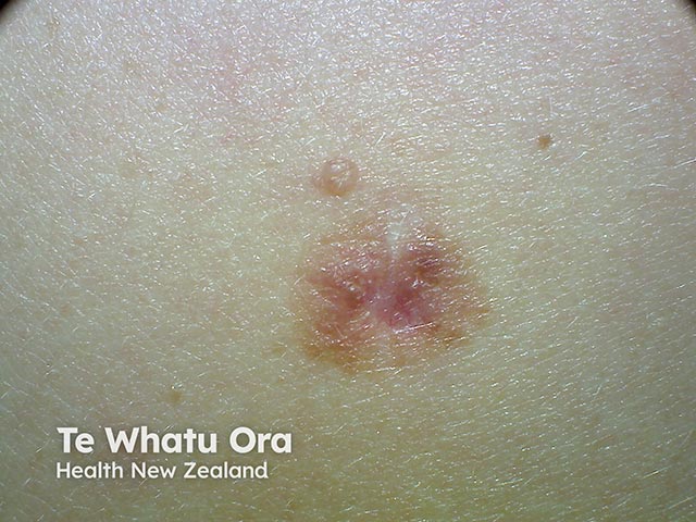 Melanoma in situ - a changing pigmented melanocytic lesion on the back