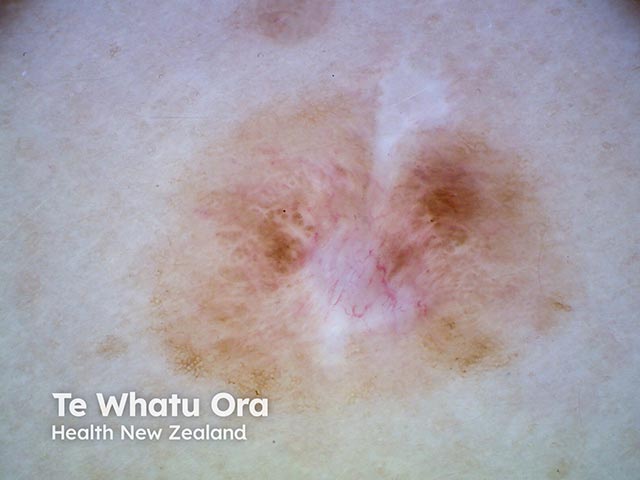 A changing melanocytic lesion - linear vessels are seen centrally