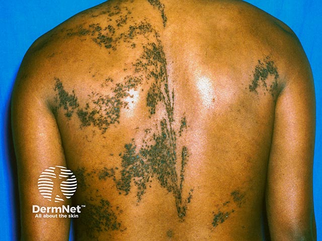 A systematised epidermal naevus with the verrucous lesions following Blaschko lines