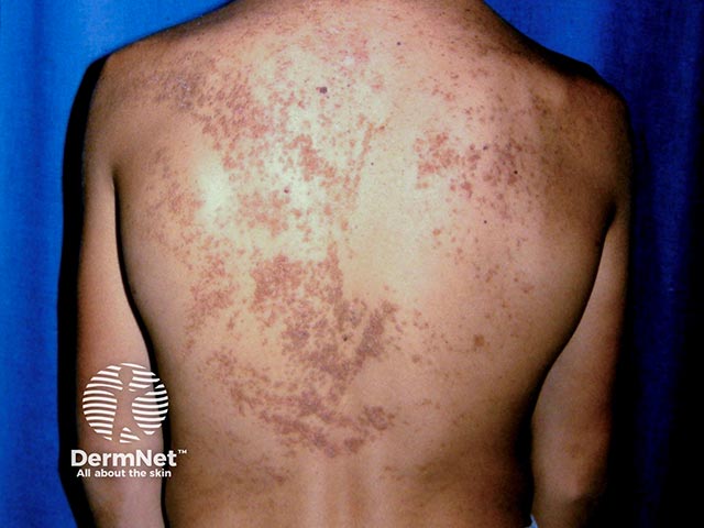 A systematised epidermal naevus showing extensive warty lesions following Blaschko lines