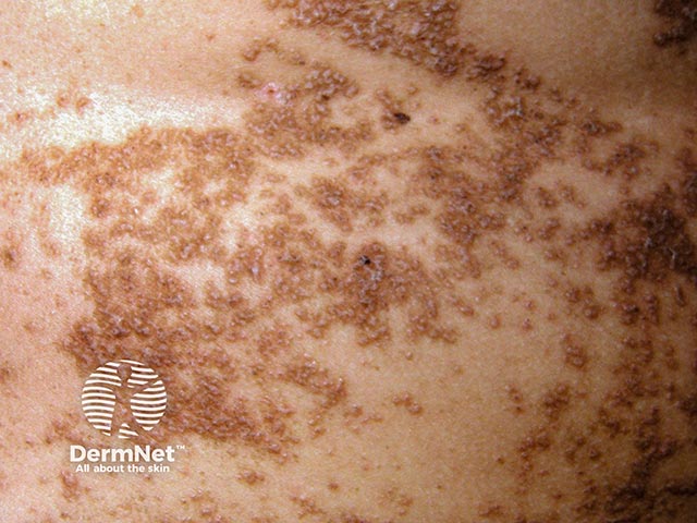 Warty papules that make up the systematised epidermal naevus