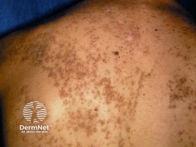 A systematised epidermal naevus