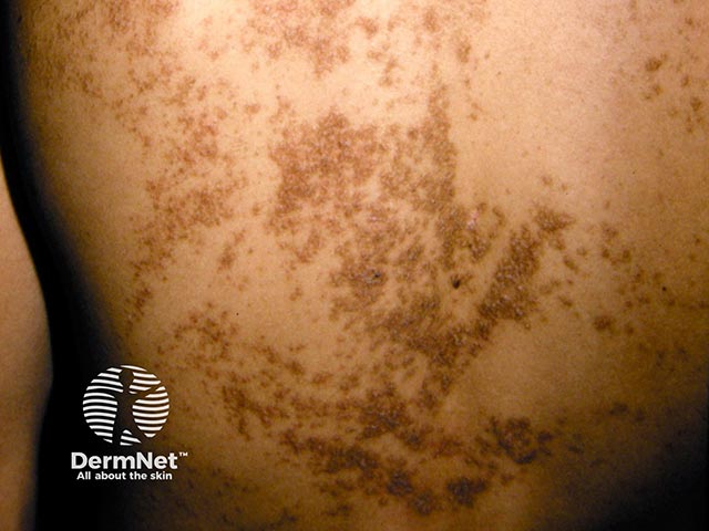 Linear lesions form part of this systematised epidermal naevus