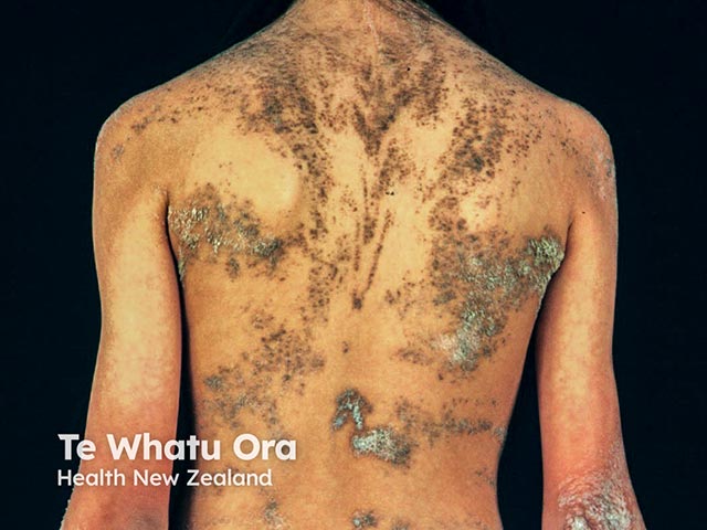 An extensive and markedly hyperkeratotic systematised epidermal naevus over the back