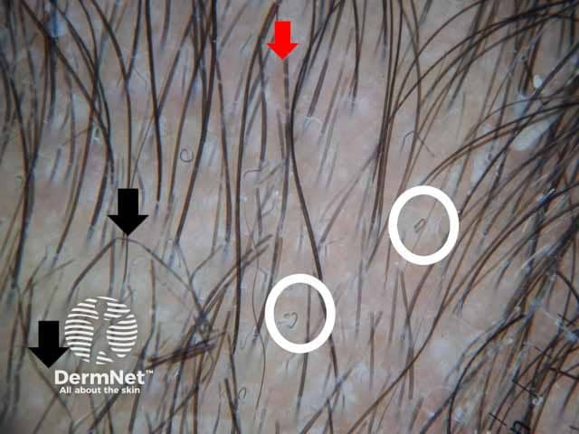 Dermoscopic image showing comma hair (white circles) zigzag hair (black arrows) and morse-code hair (red arrows) denoting tinea capitis