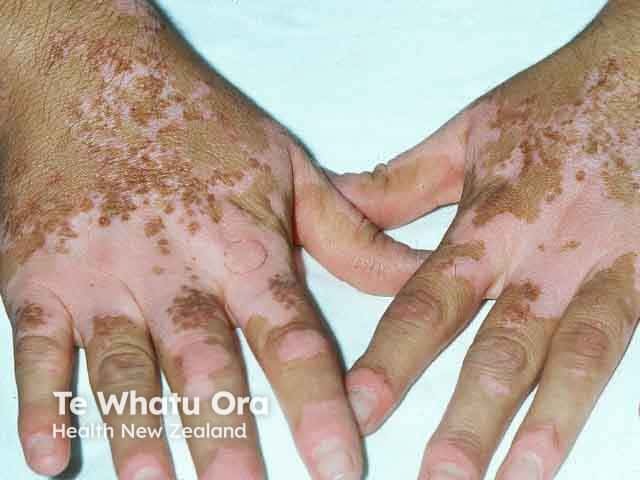 Vitiligo