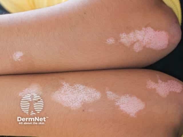 Typical well circumscribed depigmentation on the arms due to vitiligo