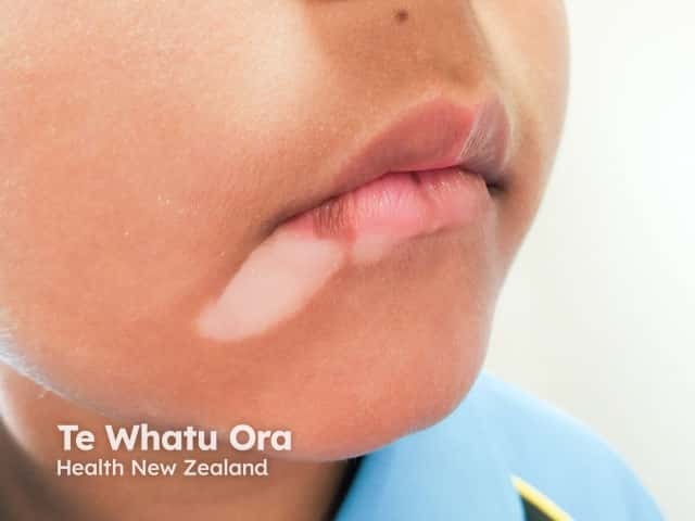 Perioral vitiligo