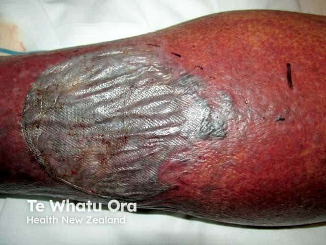 Warfarin skin necrosis on the leg