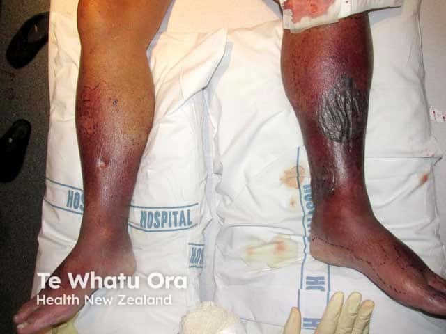 Necrosis on the left shin after commencing warfarin