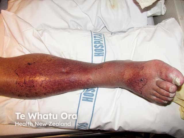 Warfarin skin necrosis