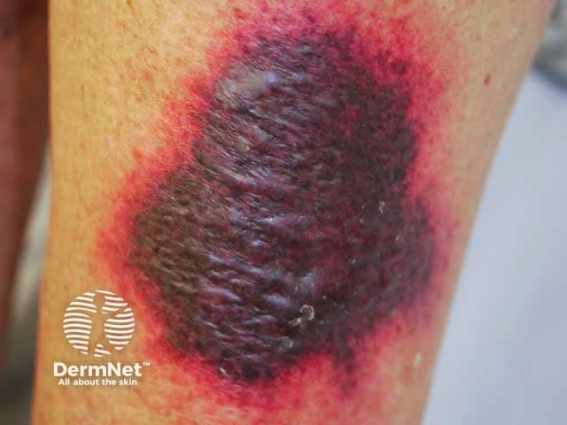 Necrosis and purpura 5 days after commencing warfarin