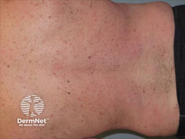 Psoriasis 6 months after commencing adalimumab